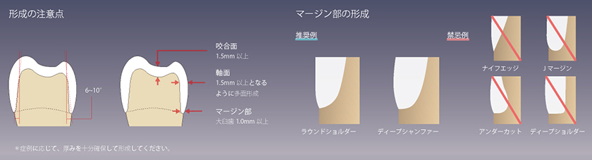 支台歯形成のポイント